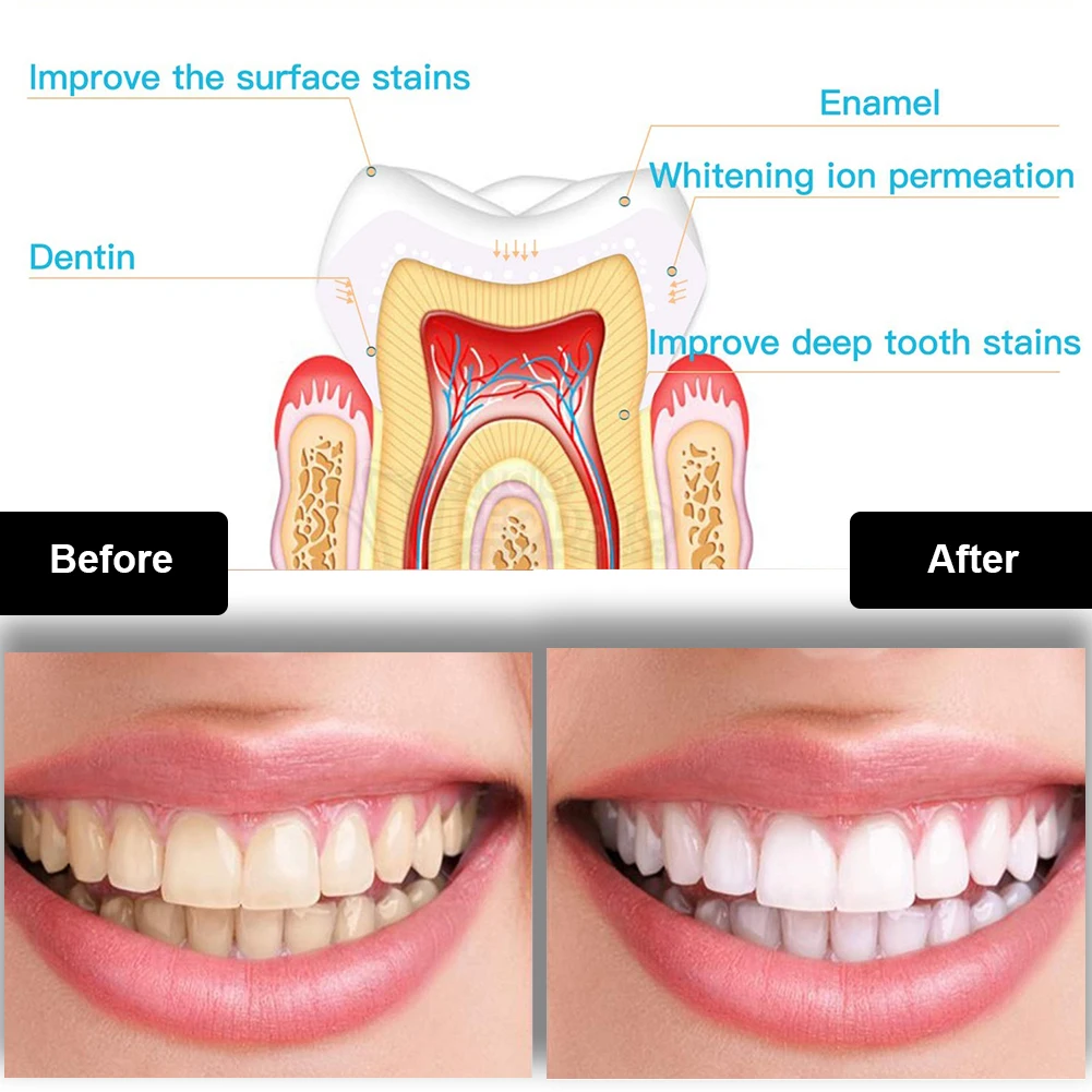 Kit de blanchiment des dents d - Teeth Whitening Near Me avis et prix