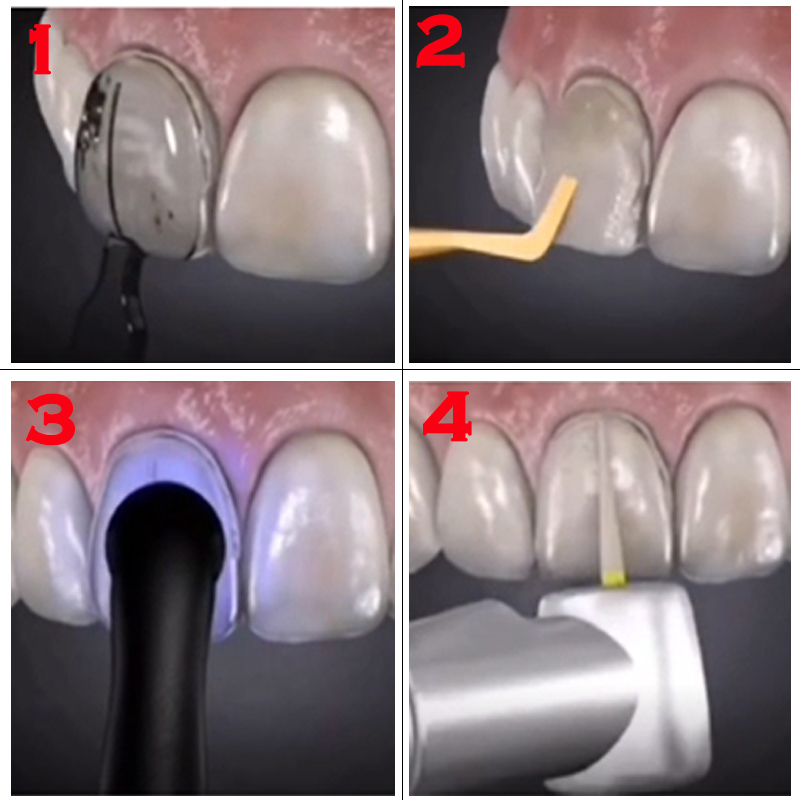 Moule de placage dentaire auto - Teeth Whitening Moulds avis et prix